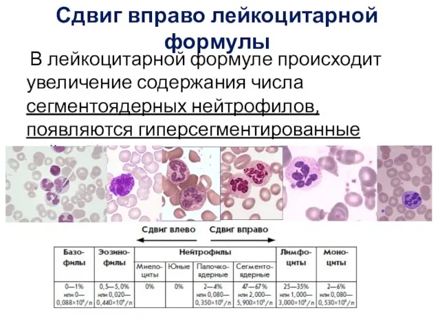 Сдвиг вправо лейкоцитарной формулы В лейкоцитарной формуле происходит увеличение содержания числа сегментоядерных нейтрофилов, появляются гиперсегментированные нейтрофилы.