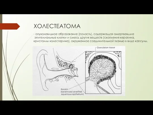 ХОЛЕСТЕАТОМА - опухолевидное образование (полость), содержащая омертвевшие эпителиальные клетки и смесь других веществ