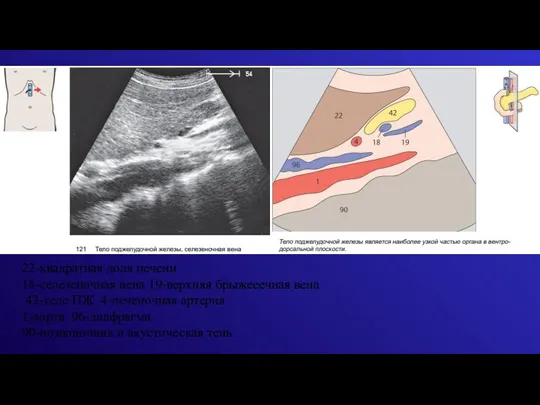 22-квадратная доля печени 18-селезеночная вена 19-верхняя брыжееечная вена 42-тело ПЖ