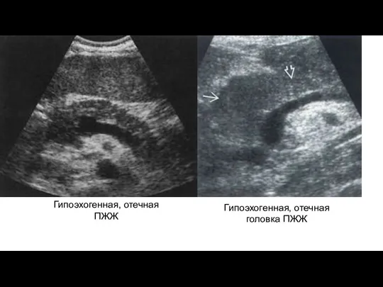 Гипоэхогенная, отечная ПЖЖ Гипоэхогенная, отечная головка ПЖЖ