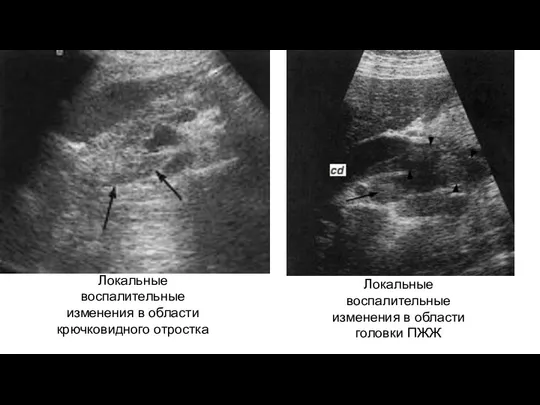 Локальные воспалительные изменения в области крючковидного отростка Локальные воспалительные изменения в области головки ПЖЖ