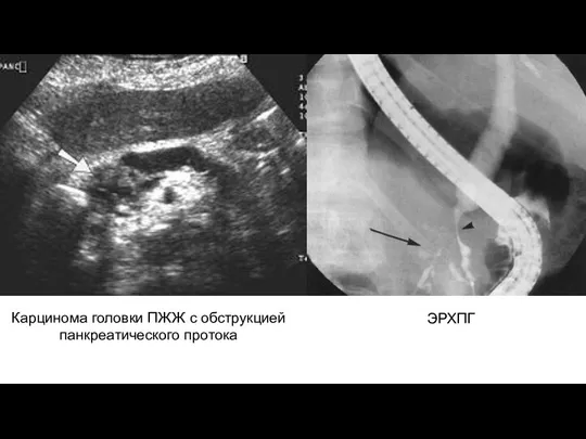 Карцинома головки ПЖЖ с обструкцией панкреатического протока ЭРХПГ