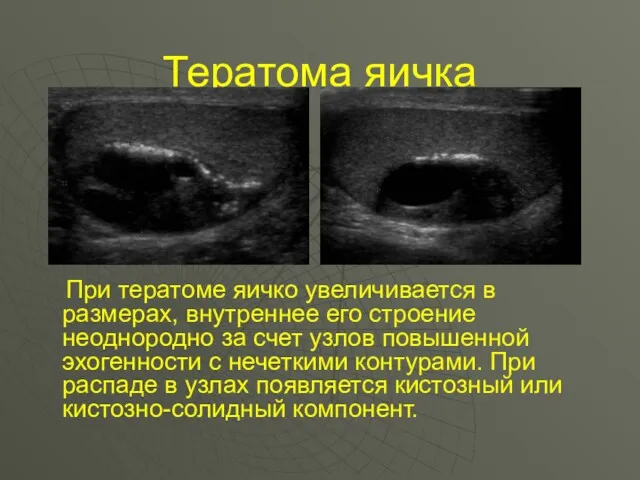 Тератома яичка При тератоме яичко увеличивается в размерах, внутреннее его строение неоднородно за