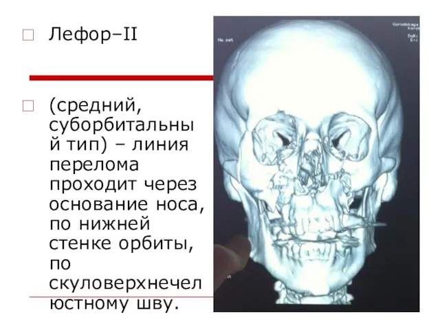 Лефор–II (средний, суборбитальный тип) – линия перелома проходит через основание