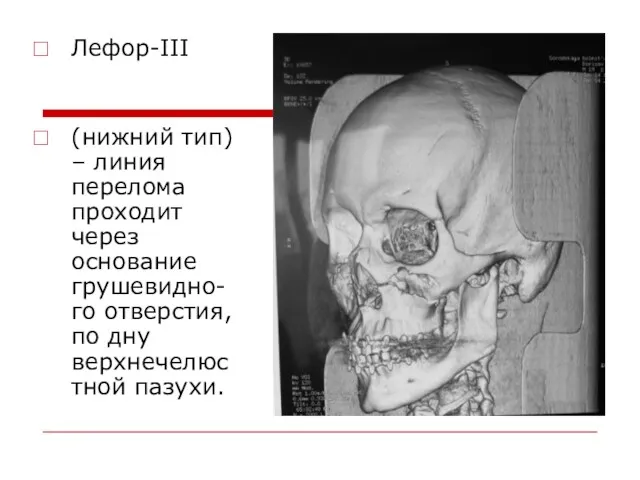 Лефор-III (нижний тип) – линия перелома проходит через основание грушевидно-го отверстия, по дну верхнечелюстной пазухи.