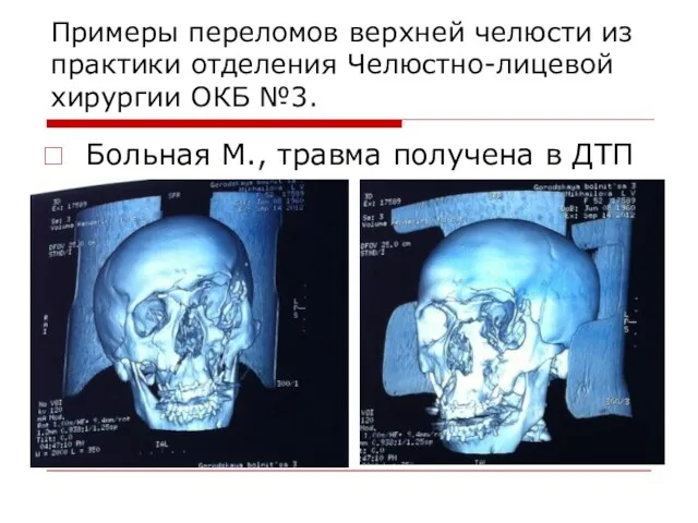 Примеры переломов верхней челюсти из практики отделения Челюстно-лицевой хирургии ОКБ