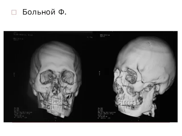 Больной Ф.