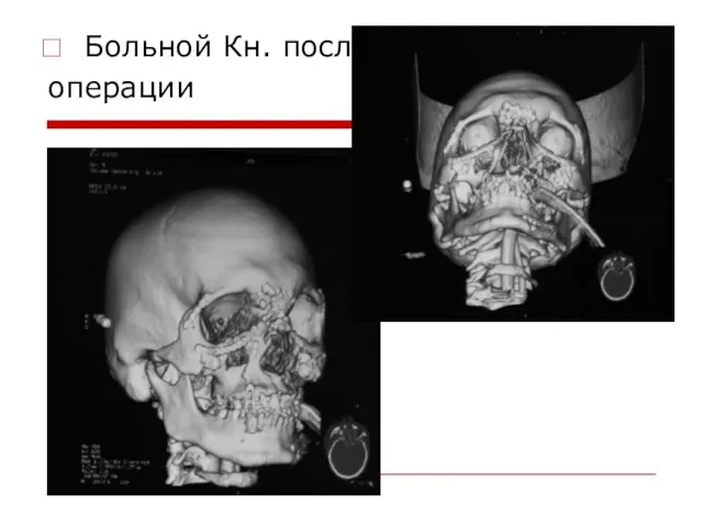 Больной Кн. после операции