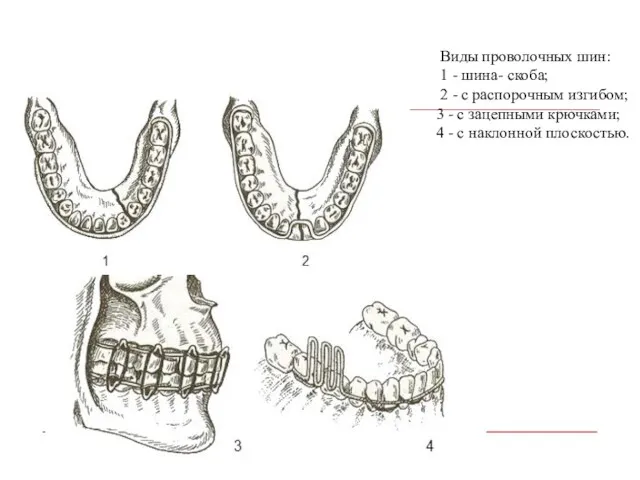 Виды проволочных шин: 1 - шина- скоба; 2 - с