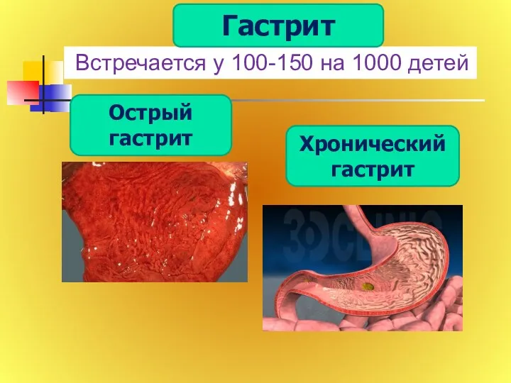 Встречается у 100-150 на 1000 детей Острый гастрит Хронический гастрит Гастрит