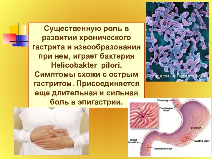Существенную роль в развитии хронического гастрита и язвообразования при нем, играет бактерия Helicobakter