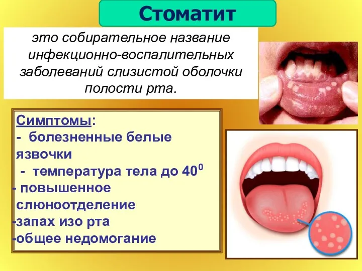 это собирательное название инфекционно-воспалительных заболеваний слизистой оболочки полости рта. Симптомы: