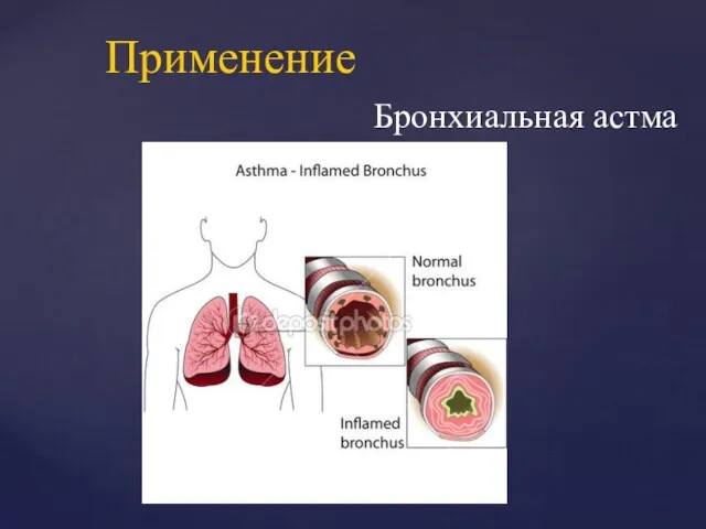 Бронхиальная астма Применение