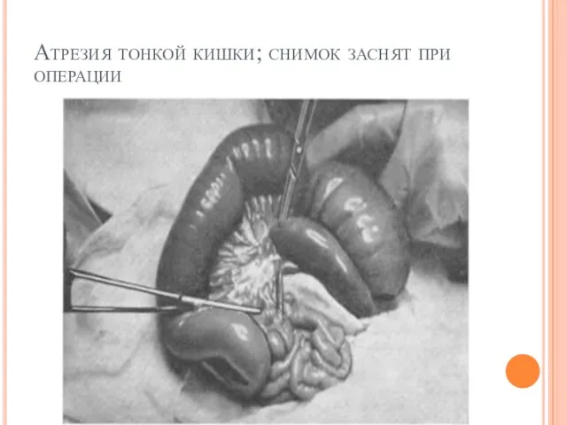 Атрезия тонкой кишки; снимок заснят при операции