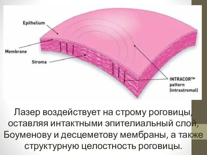 Лазер воздействует на строму роговицы, оставляя интактными эпителиальный слой, Боуменову