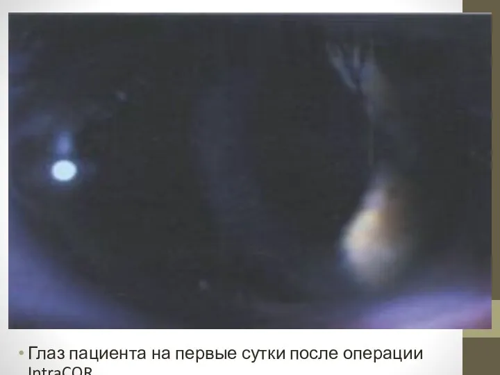 Глаз пациента на первые сутки после операции IntraCOR