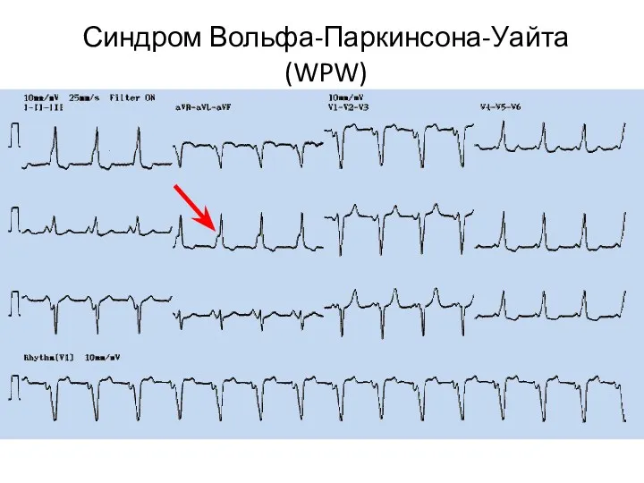 Синдром Вольфа-Паркинсона-Уайта (WPW)