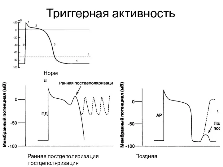 Триггерная активность Ранняя постдеполяризация Поздняя постдеполяризация Норма