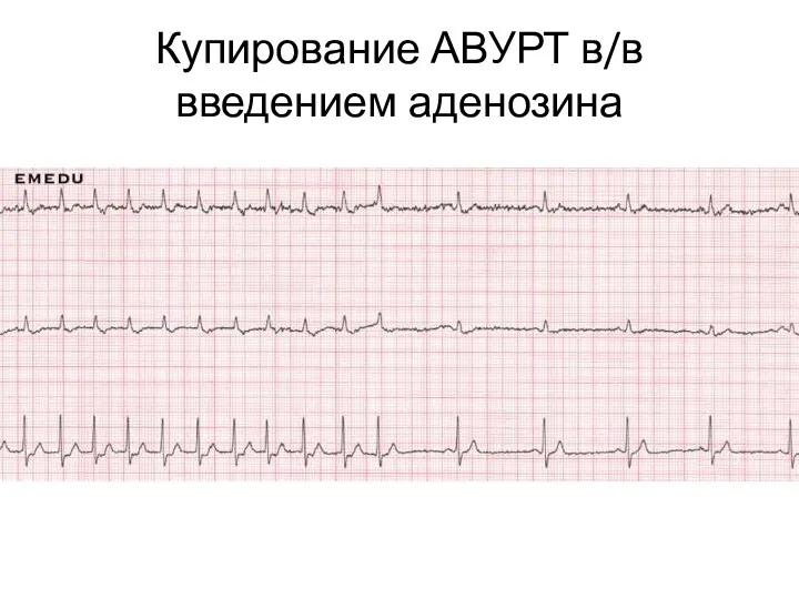 Купирование АВУРТ в/в введением аденозина