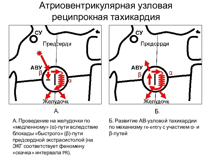 Атриовентрикулярная узловая реципрокная тахикардия А. Проведение на желудочки по «медленному»