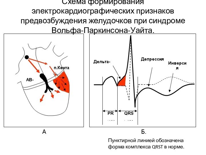 Схема формирования электрокардиографических признаков предвозбуждения желудочков при синдроме Вольфа-Паркинсона-Уайта. Пунктирной