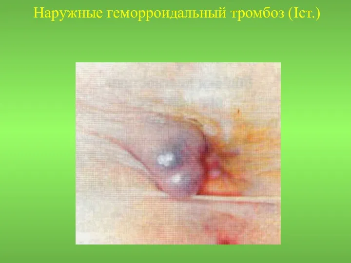 Наружные геморроидальный тромбоз (Iст.)