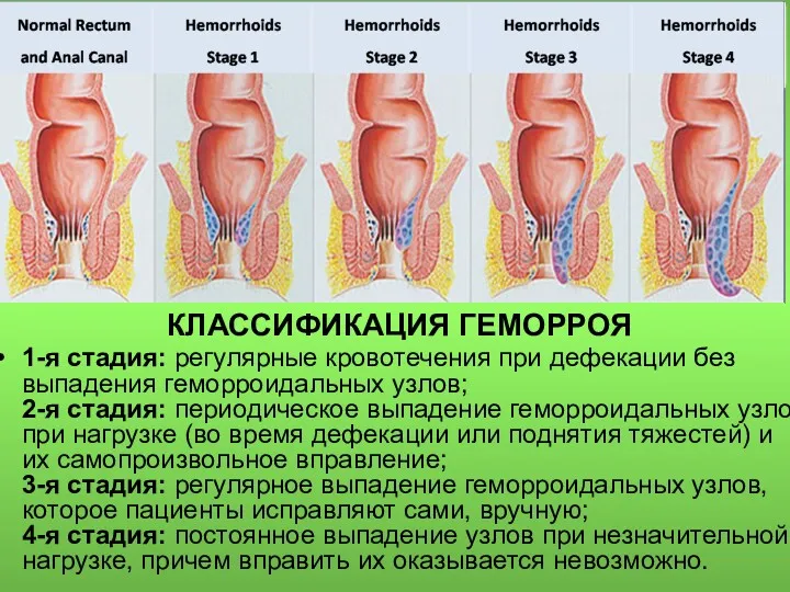 КЛАССИФИКАЦИЯ ГЕМОРРОЯ 1-я стадия: регулярные кровотечения при дефекации без выпадения