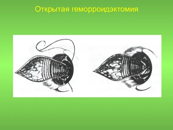 Открытая геморроидэктомия