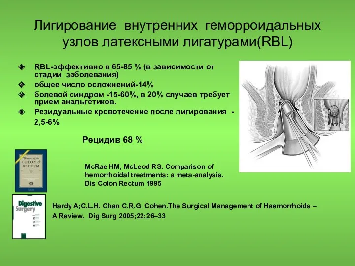 Лигирование внутренних геморроидальных узлов латексными лигатурами(RBL) RBL-эффективно в 65-85 %