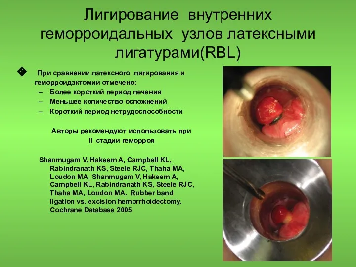 Лигирование внутренних геморроидальных узлов латексными лигатурами(RBL) При сравнении латексного лигирования