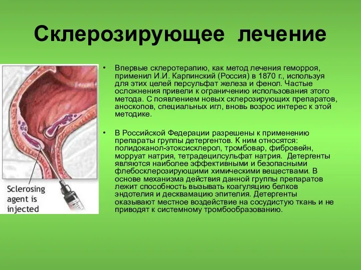 Склерозирующее лечение Впервые склеротерапию, как метод лечения геморроя, применил И.И.