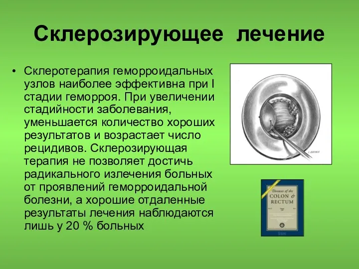 Склерозирующее лечение Склеротерапия геморроидальных узлов наиболее эффективна при I стадии