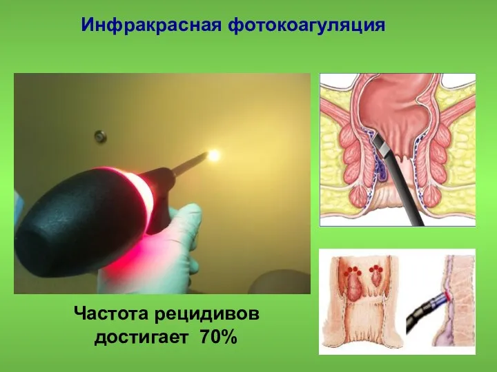 Частота рецидивов достигает 70% Инфракрасная фотокоагуляция