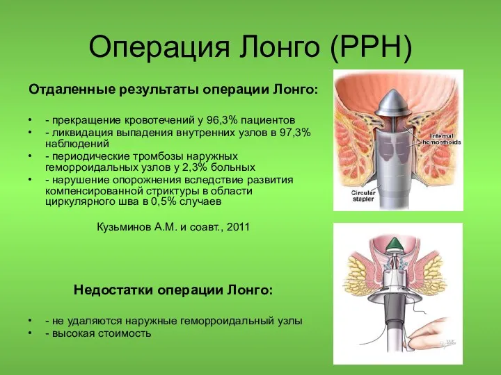 Операция Лонго (PPH) Отдаленные результаты операции Лонго: - прекращение кровотечений