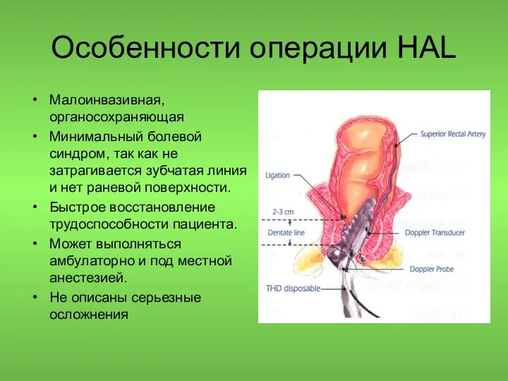 Особенности операции HAL Малоинвазивная, органосохраняющая Минимальный болевой синдром, так как