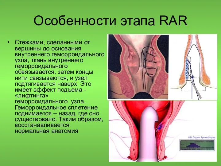 Особенности этапа RAR Стежками, сделанными от вершины до основания внутреннего