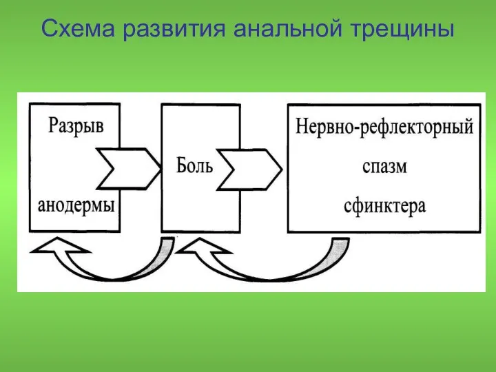 Схема развития анальной трещины