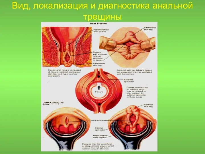 Вид, локализация и диагностика анальной трещины
