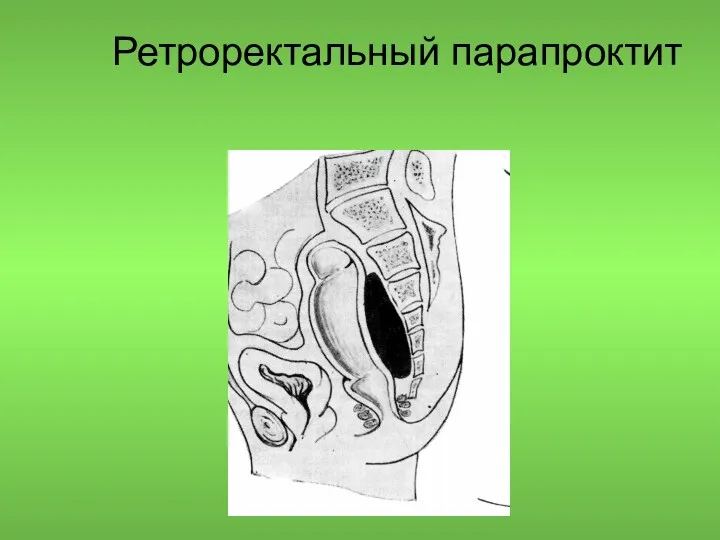 Ретроректальный парапроктит