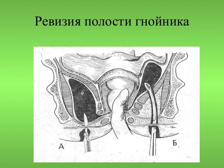 Ревизия полости гнойника