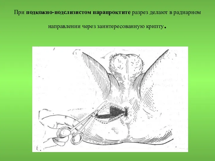 При подкожно-подслизистом парапроктите разрез делают в радиарном направлении через заинтересованную крипту.
