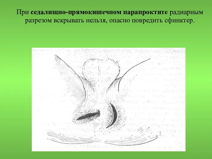 При седалищно-прямокишечном парапроктите радиарным разрезом вскрывать нельзя, опасно повредить сфинктер.