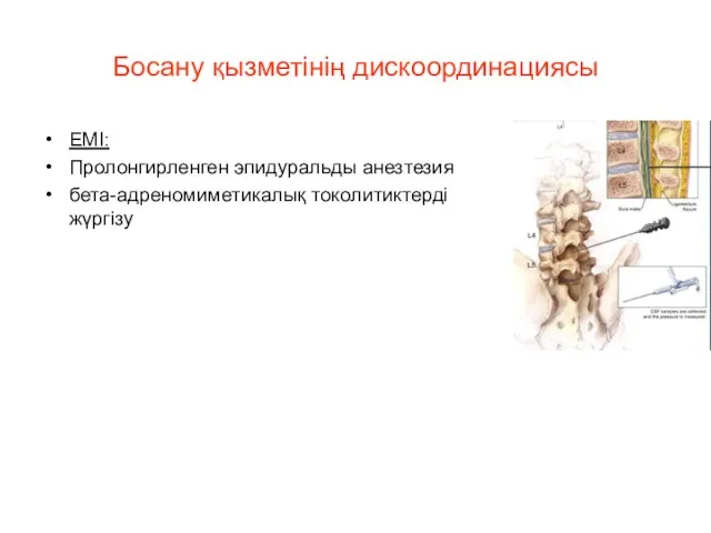 Босану қызметінің дискоординациясы ЕМІ: Пролонгирленген эпидуральды анезтезия бета-адреномиметикалық токолитиктерді жүргізу