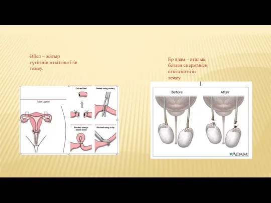 Әйел – жатыр түтігінің өткізгіштігін тежеу. Ер адам – аталық безден сперманың өткізгіштігін тежеу