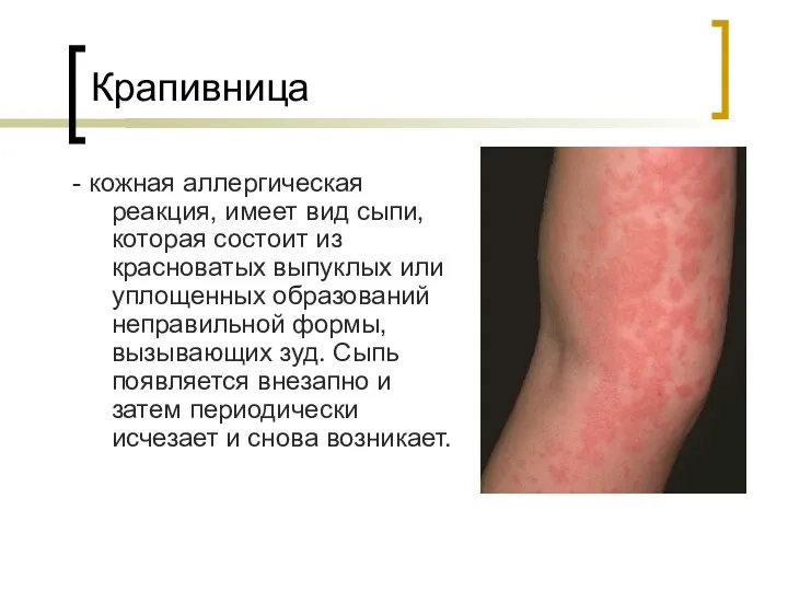Крапивница - кожная аллергическая реакция, имеет вид сыпи, которая состоит