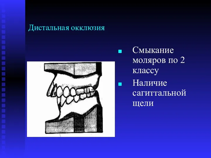 Дистальная окклюзия Смыкание моляров по 2 классу Наличие сагиттальной щели