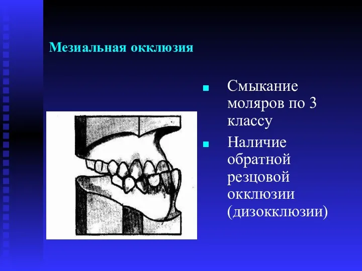 Мезиальная окклюзия Смыкание моляров по 3 классу Наличие обратной резцовой окклюзии (дизокклюзии)