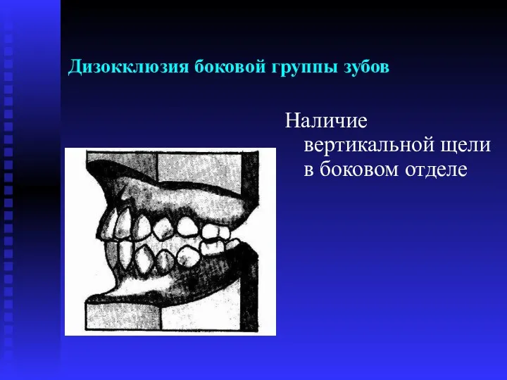 Дизокклюзия боковой группы зубов Наличие вертикальной щели в боковом отделе