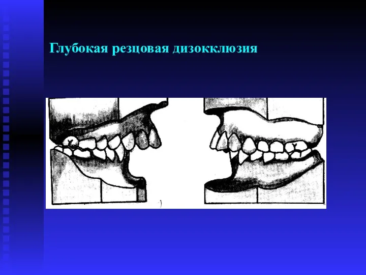 Глубокая резцовая дизокклюзия