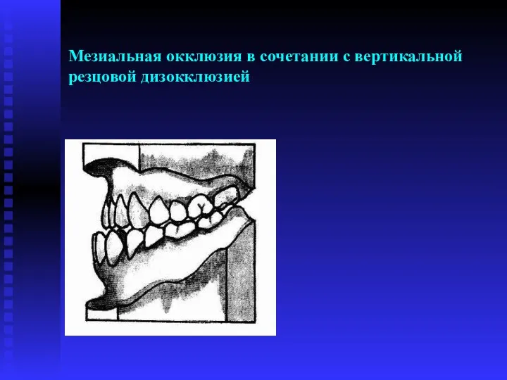 Мезиальная окклюзия в сочетании с вертикальной резцовой дизокклюзией